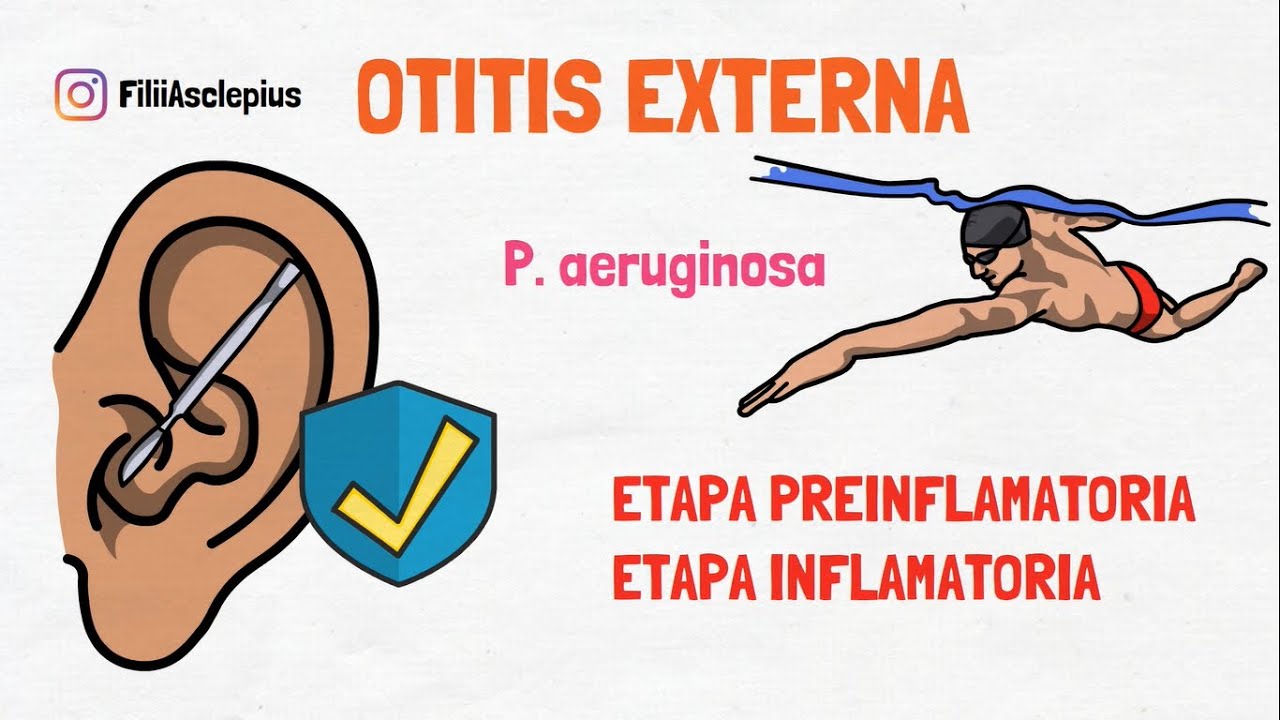 OTITIS EXTERNA AGUDA - DIAGNÓSTICO Y TRATAMIENTO.