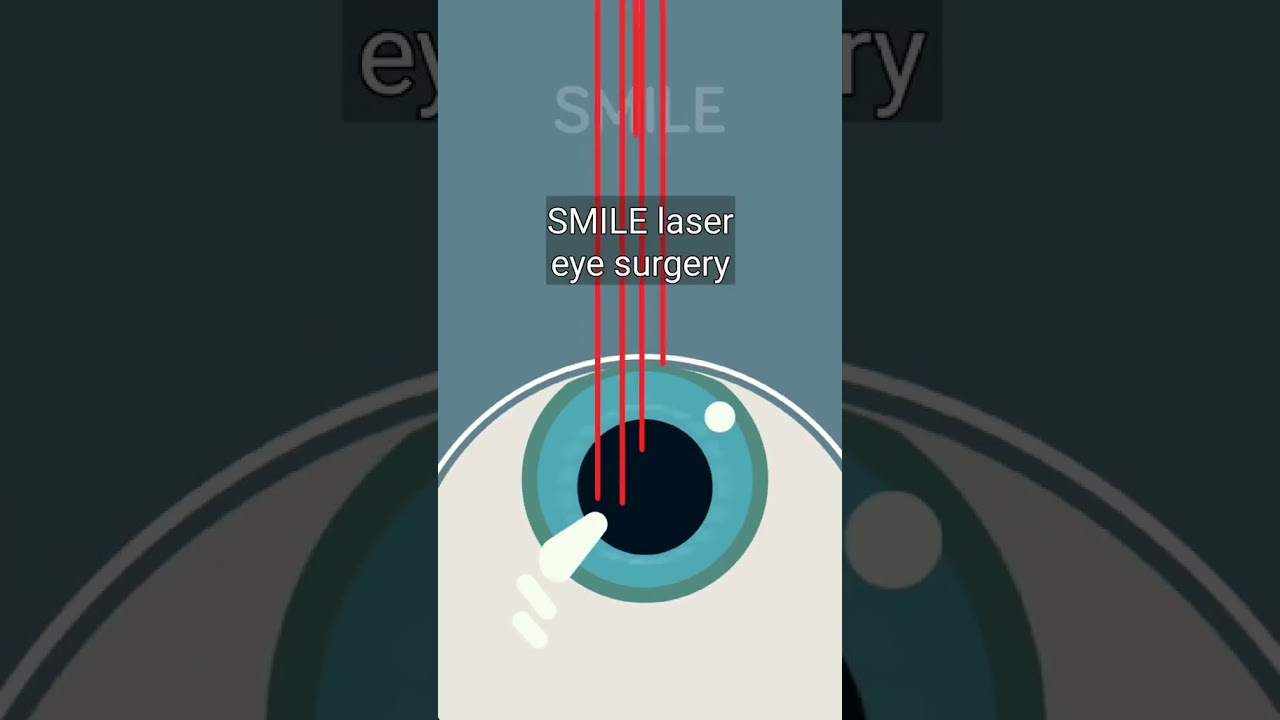 How Laser Eye Surgery Works! #shorts
