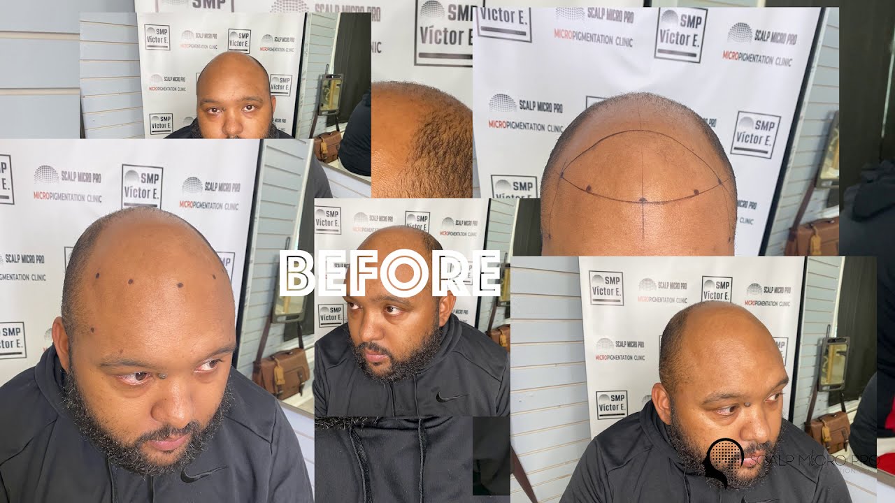 watch this amazing before and after SMP procedure