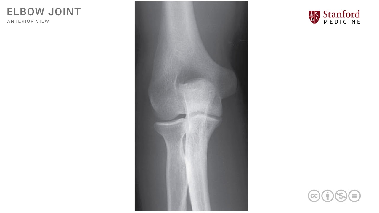 Anatomy of the Upper Limb: Osteology of Elbow Region and Elbow Joint