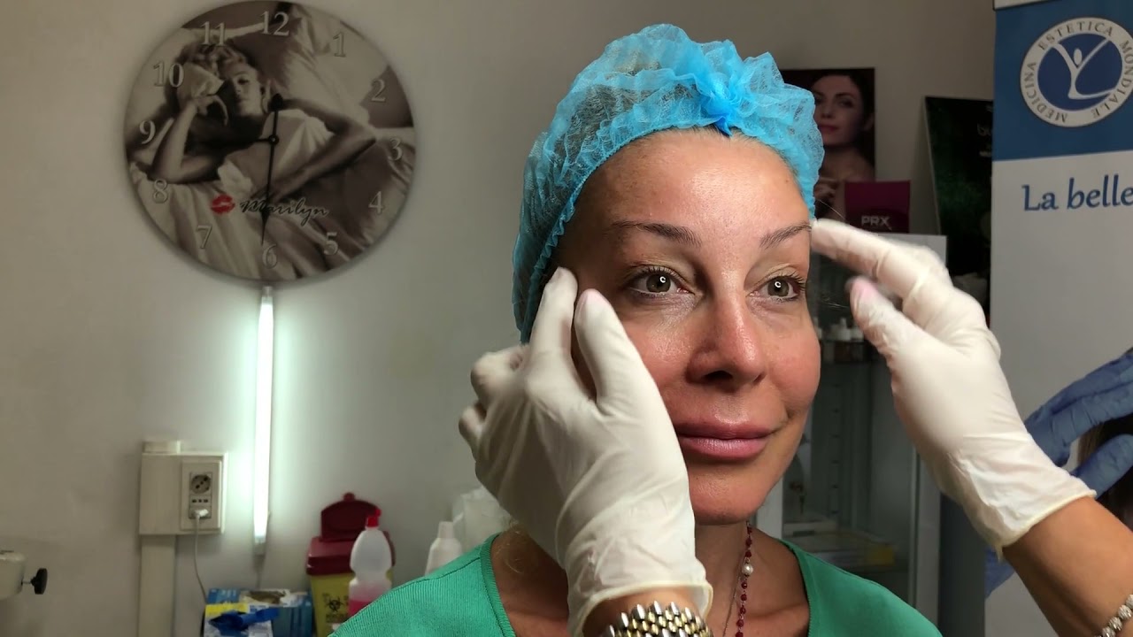 BOTOX TOSSINA BOTULINICA