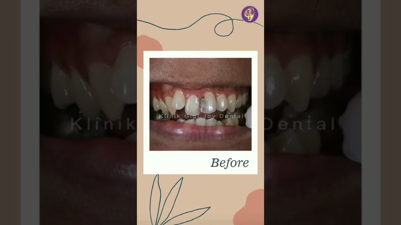BEFORE AFTER TAMBAL GIGI DI KLINIK GIGI JOY DENTAL