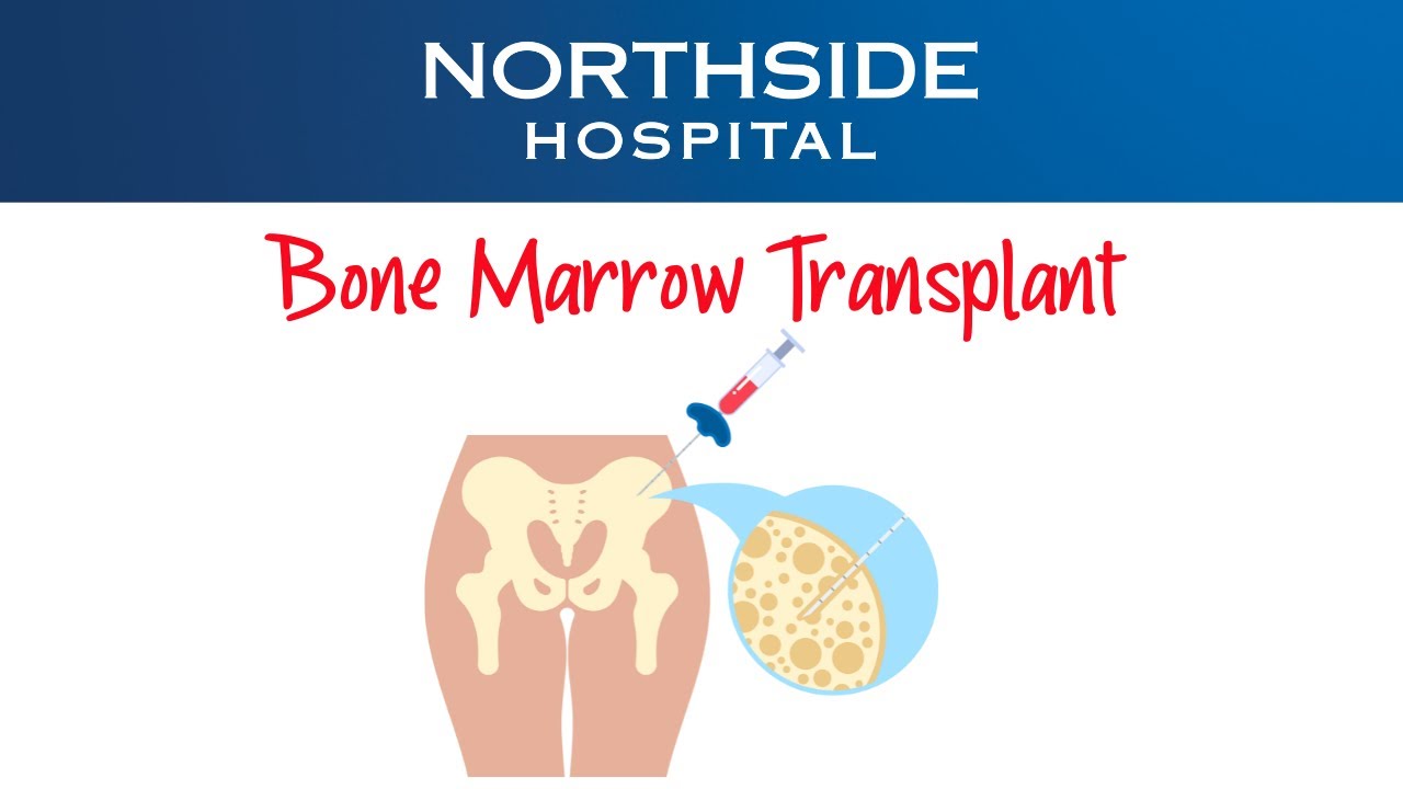 What You Need to Know About Bone Marrow Transplants