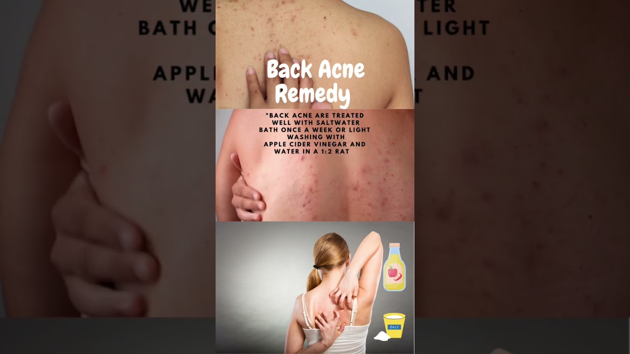 3 Home remedies for back acne 🌿#homeremedies #preventivehealthcare #healthylifestyle #health
