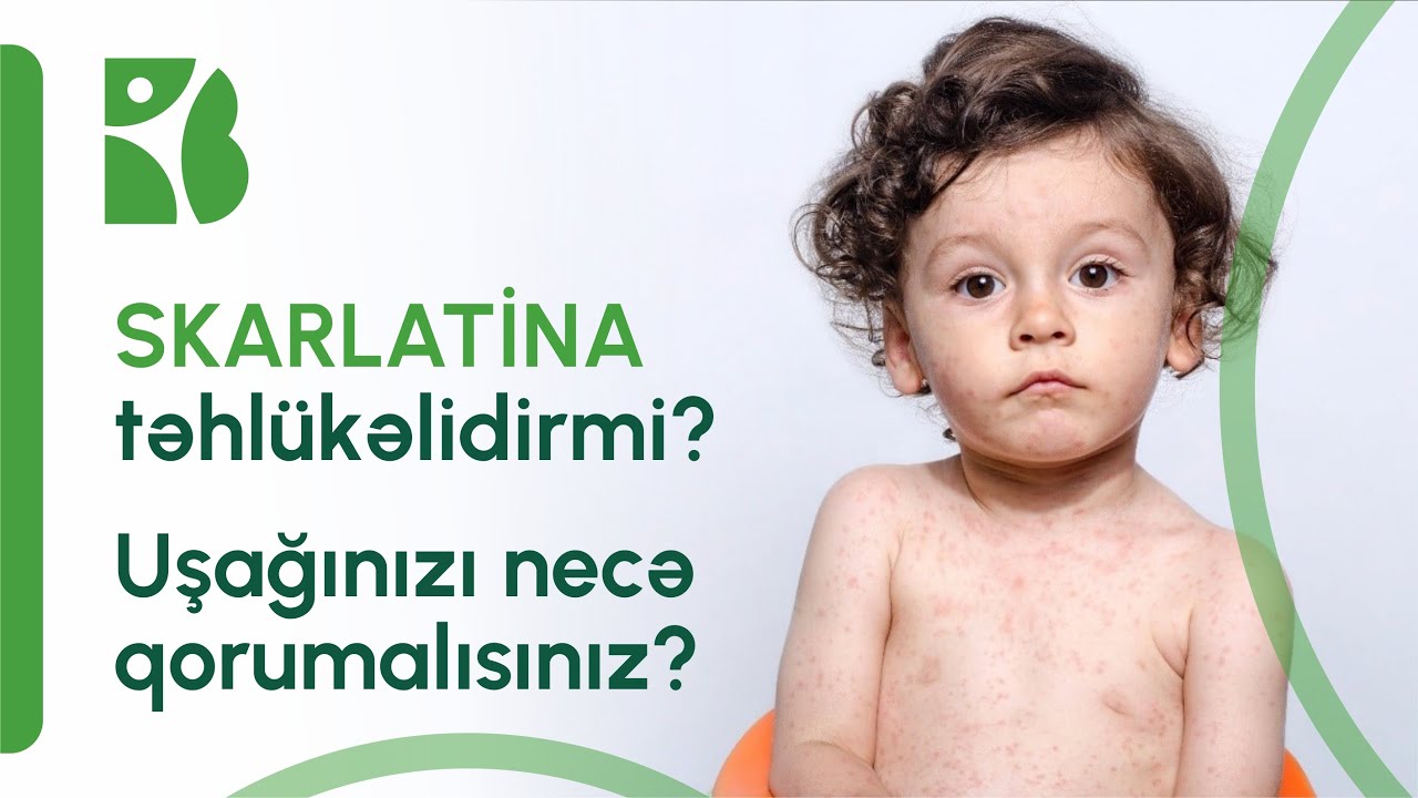 Skarlatina uşaqlarda necə yaranır? Valideynlər üçün vacib məsləhətlər