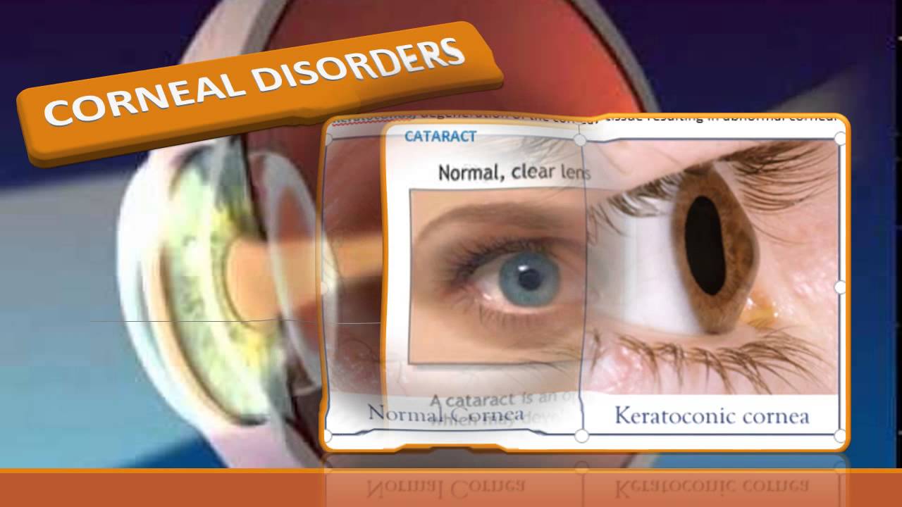 Care of Patients with Eye & Vision Disorders