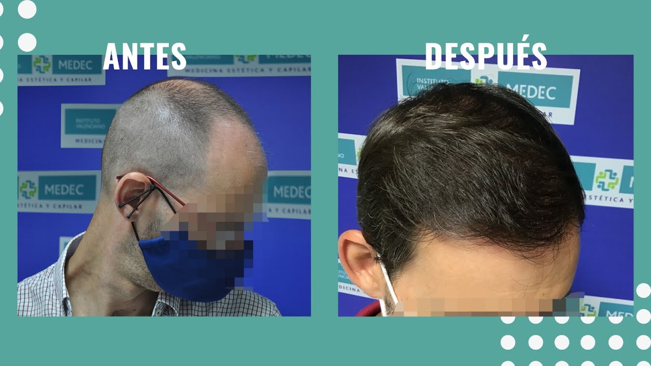 🙋‍‍ CASO REAL Injerto Capilar antes y después - 3.581 UFS - Resultados increíbles 👏‍‍