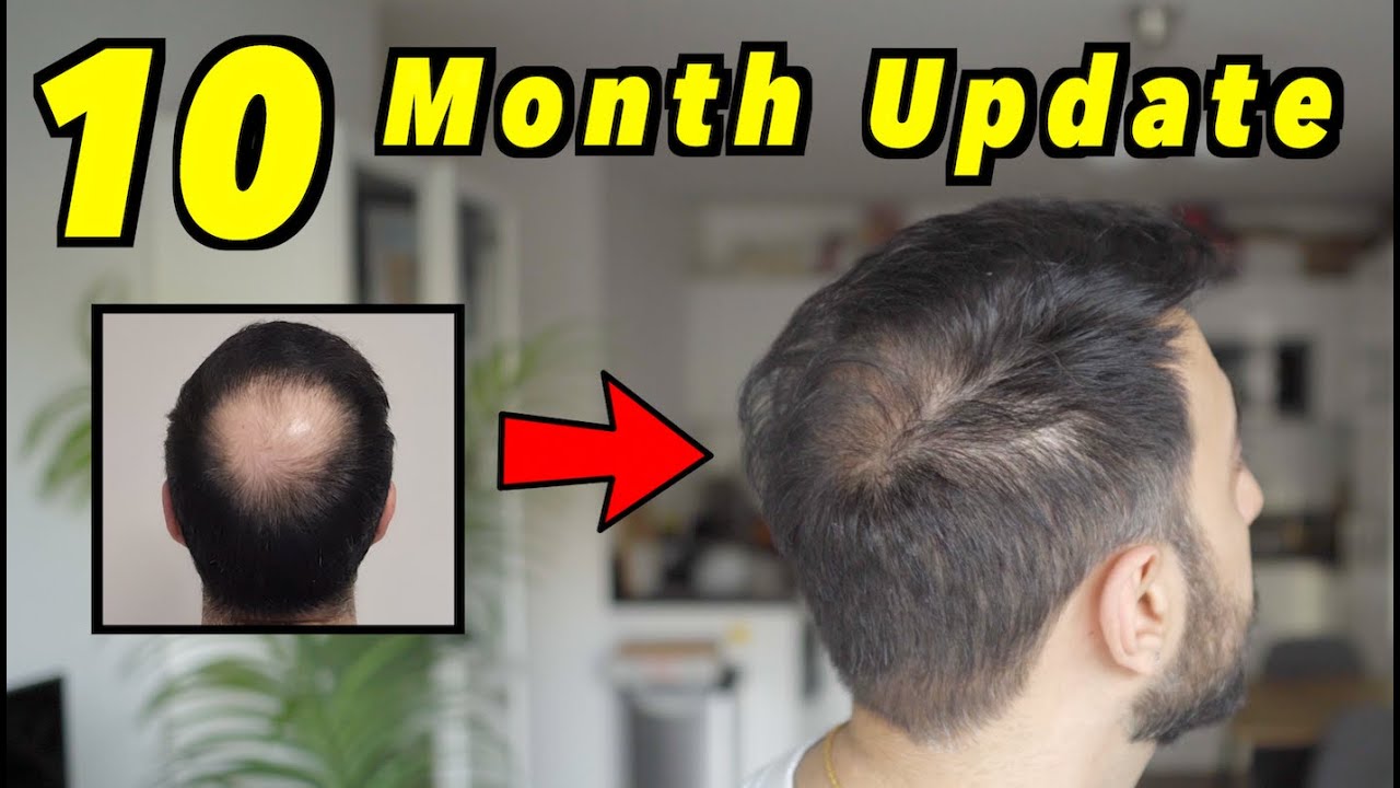 10 Month 2nd Hair Transplant Update | 4000 GRAFTS FUE | HAIR IS GROWING | SMP?