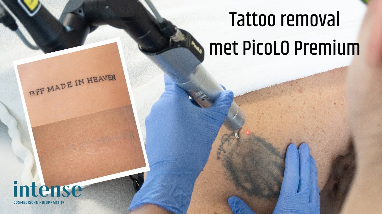 Tatoeage verwijderen met Pico laser