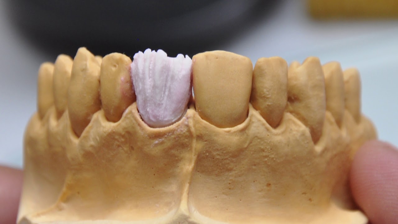 G Ceram Porcelain Build Up