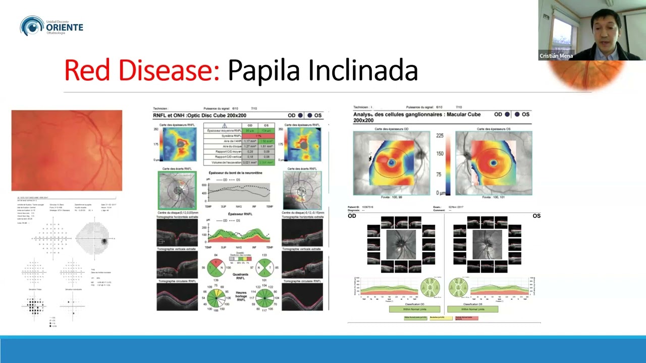 Glaucoma y OCT