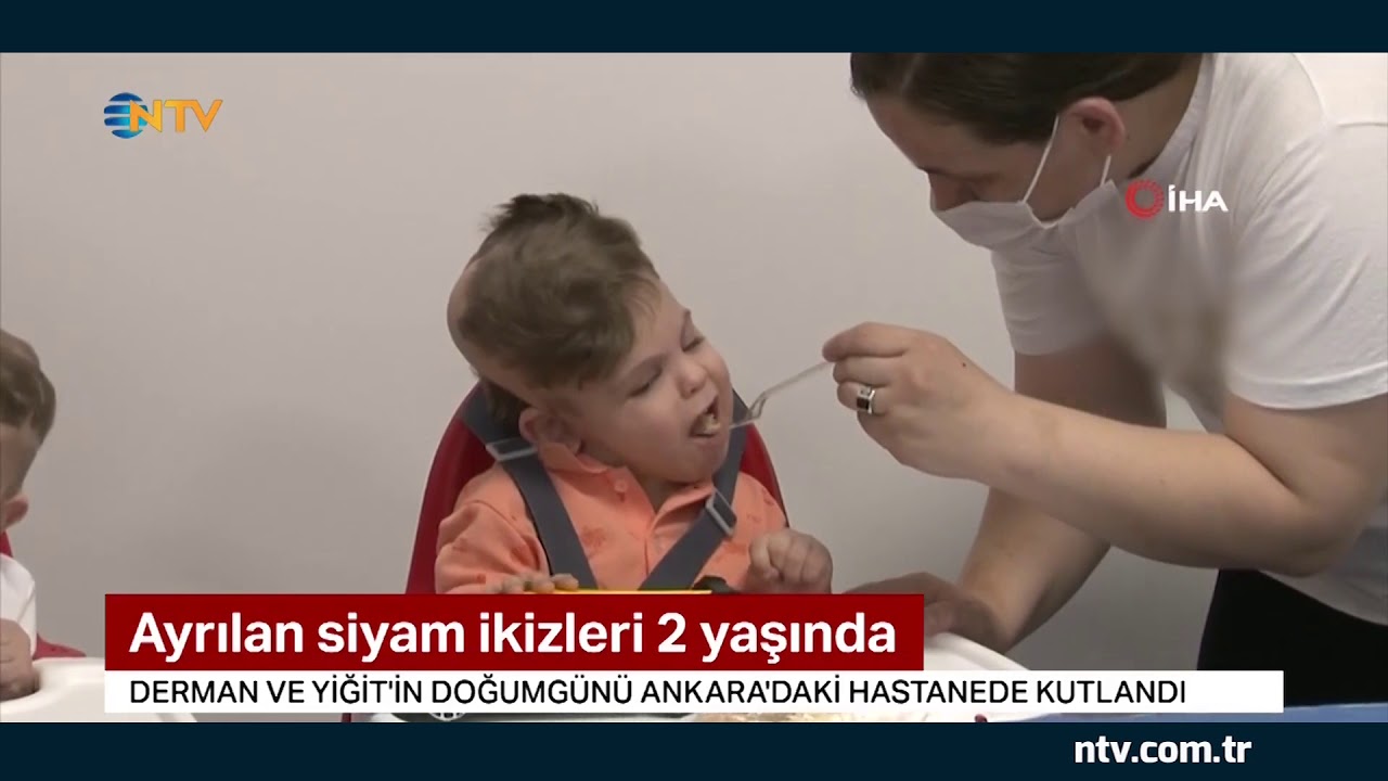 Ayrılan siyam ikizleri 2 yaşında
