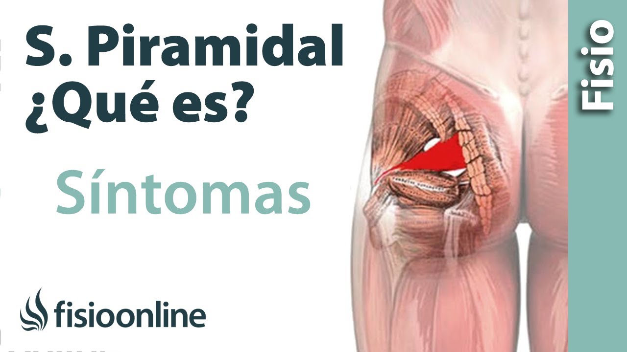 &iquest;Qu&eacute; es el s&iacute;ndrome del m&uacute;sculo piramidal y cu&aacute;les son sus s&iacute;ntomas y causas?