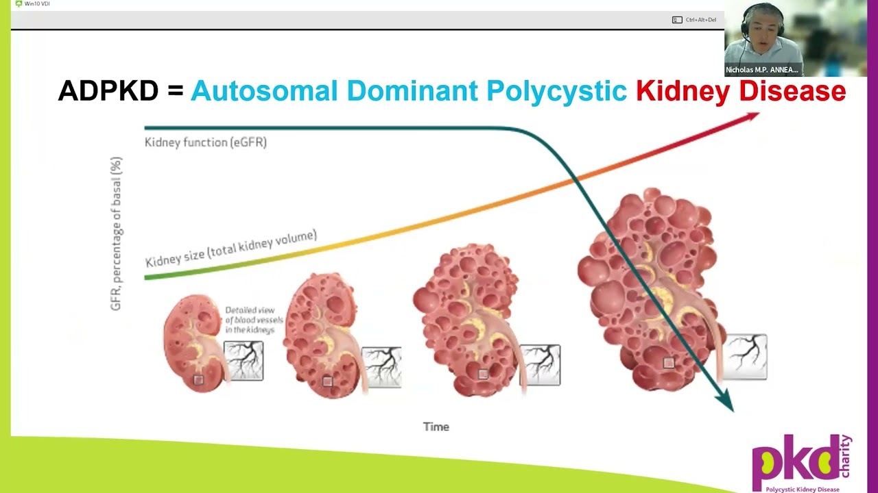 ADPKD (Autosomal Dominant Polycystic Kidney Disease) Basics 2024