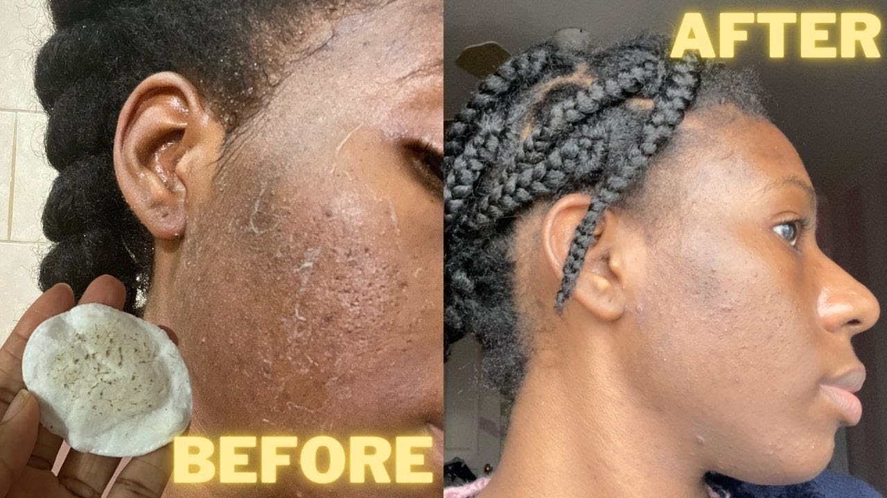 PCA SKIN CHEMICAL PEEL FULL EXPERIENCE | BEFORE & AFTER | * raw *