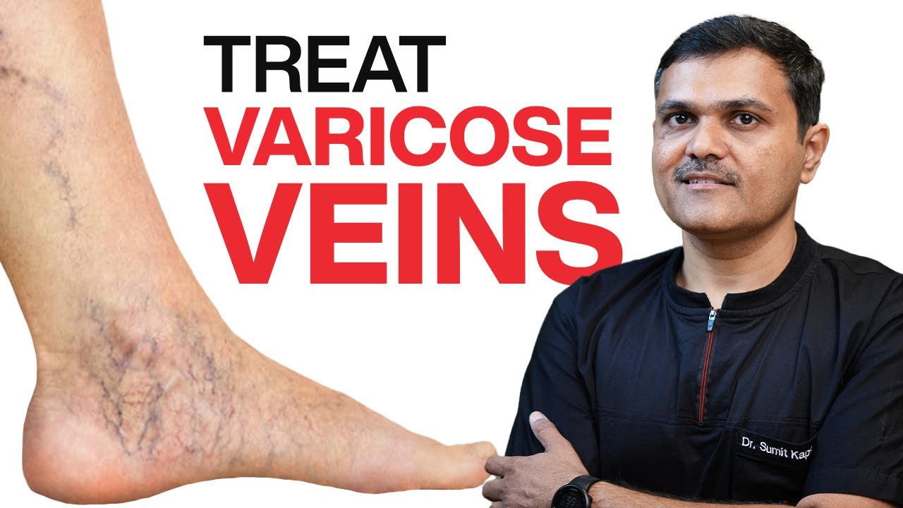 VASCULAR SURGEON Shares 11 Proven Ways to TREAT VARICOSE VEINS