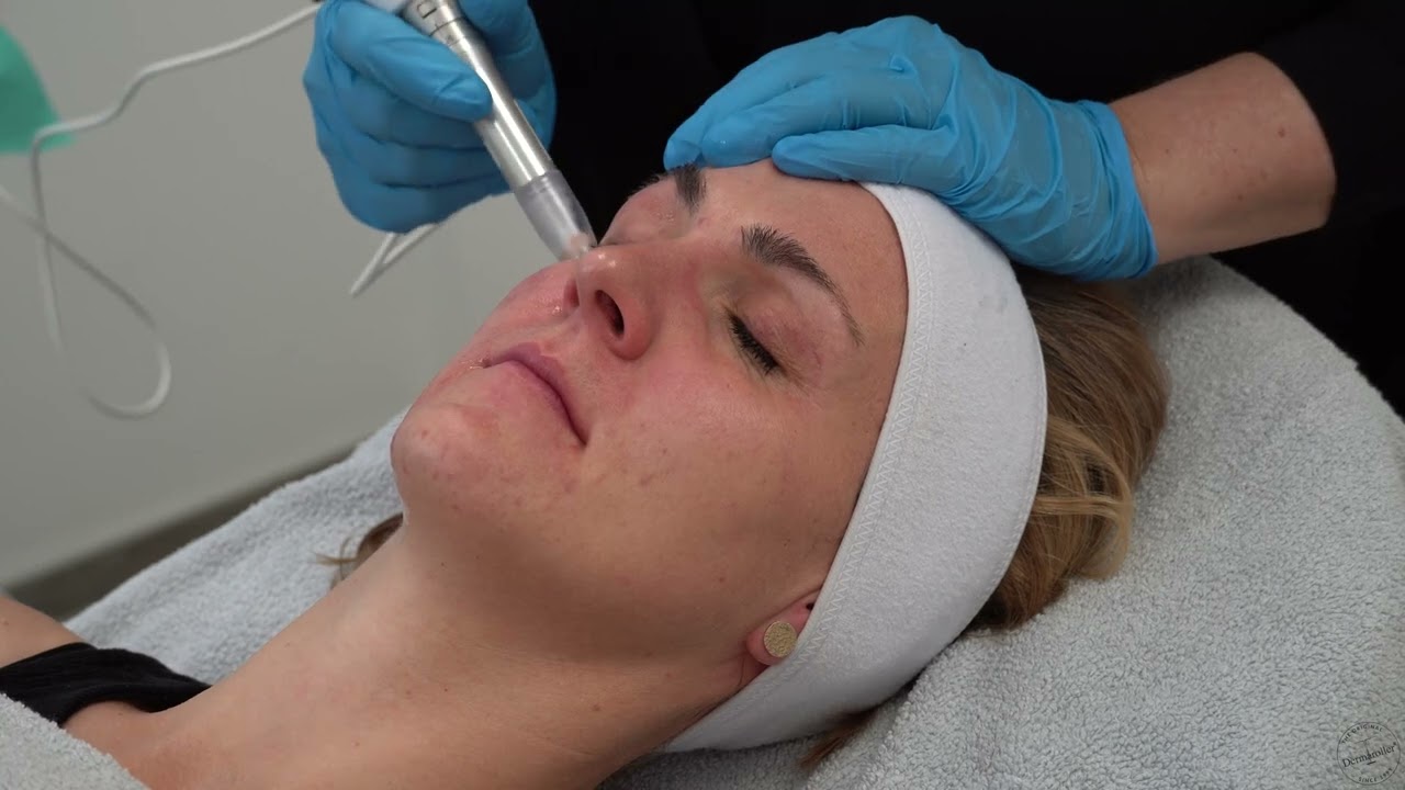 Collagen Induction Therapy with XCellarisPRO TWIST