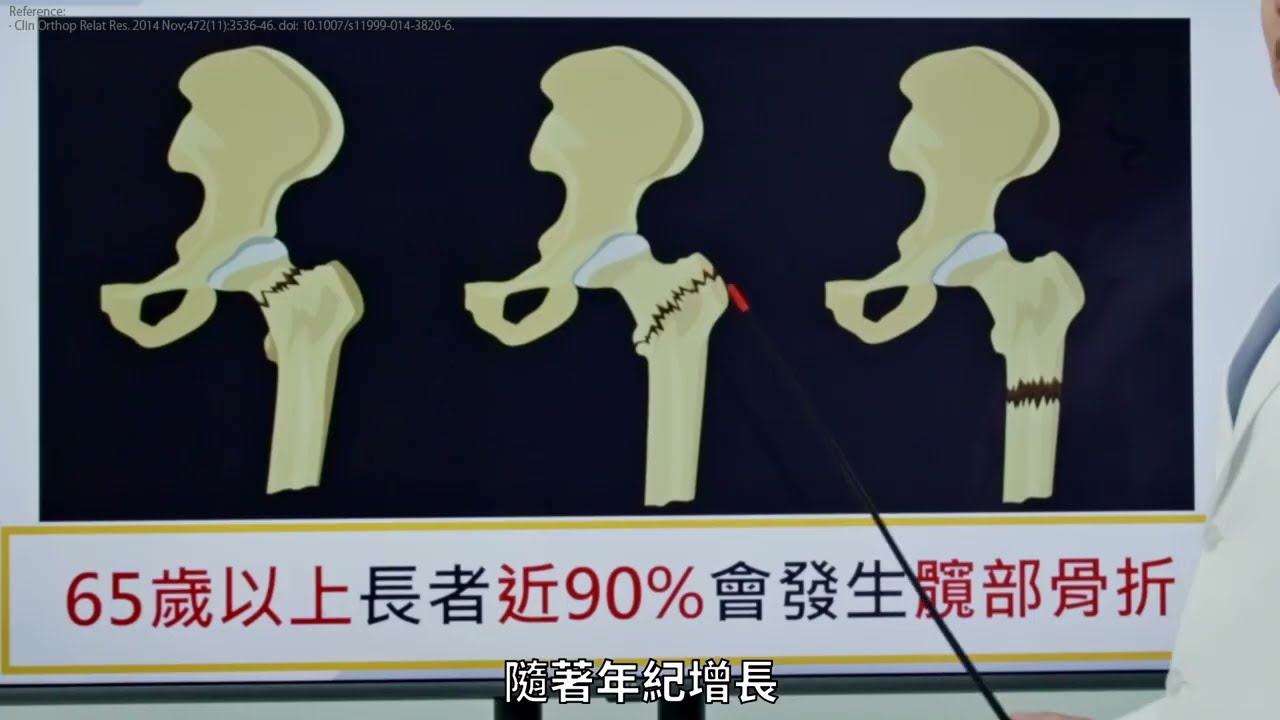 骨鬆與髖部骨折｜許皓為醫師