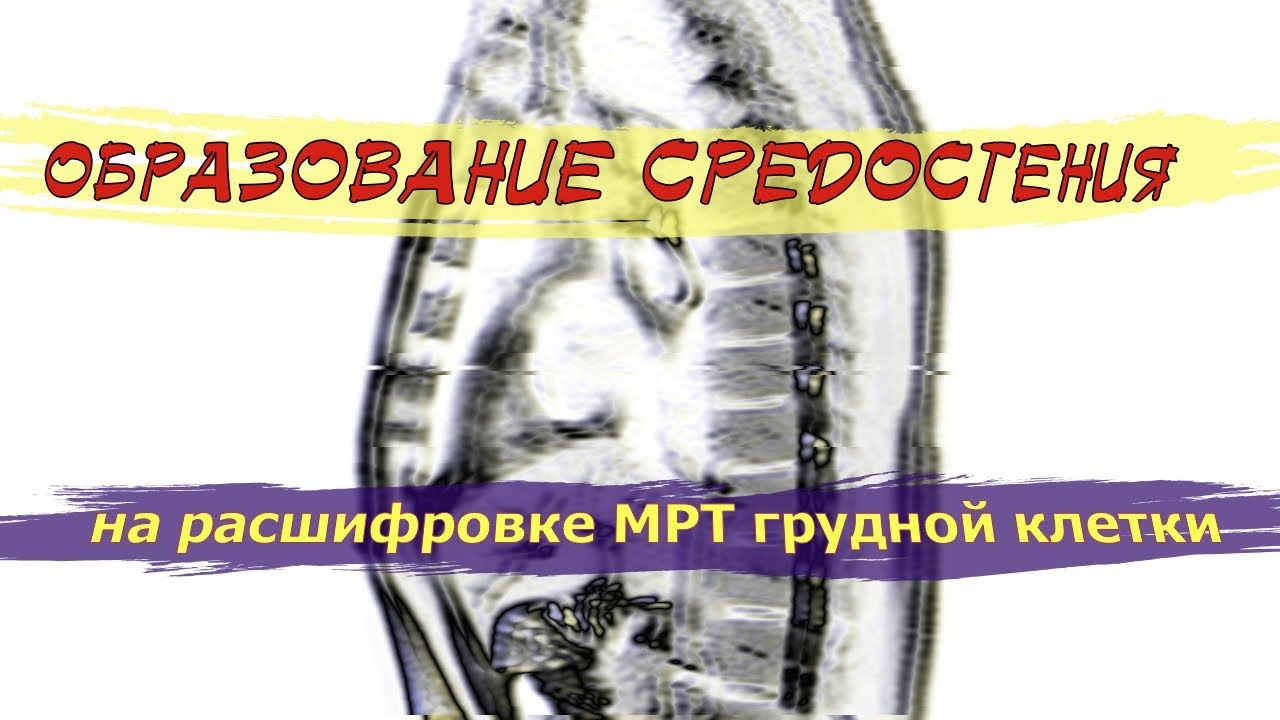 ОБРАЗОВАНИЕ средостения (ТИМОМА и ее диагностика) на РАСШИФРОВКЕ МРТ грудной клетки