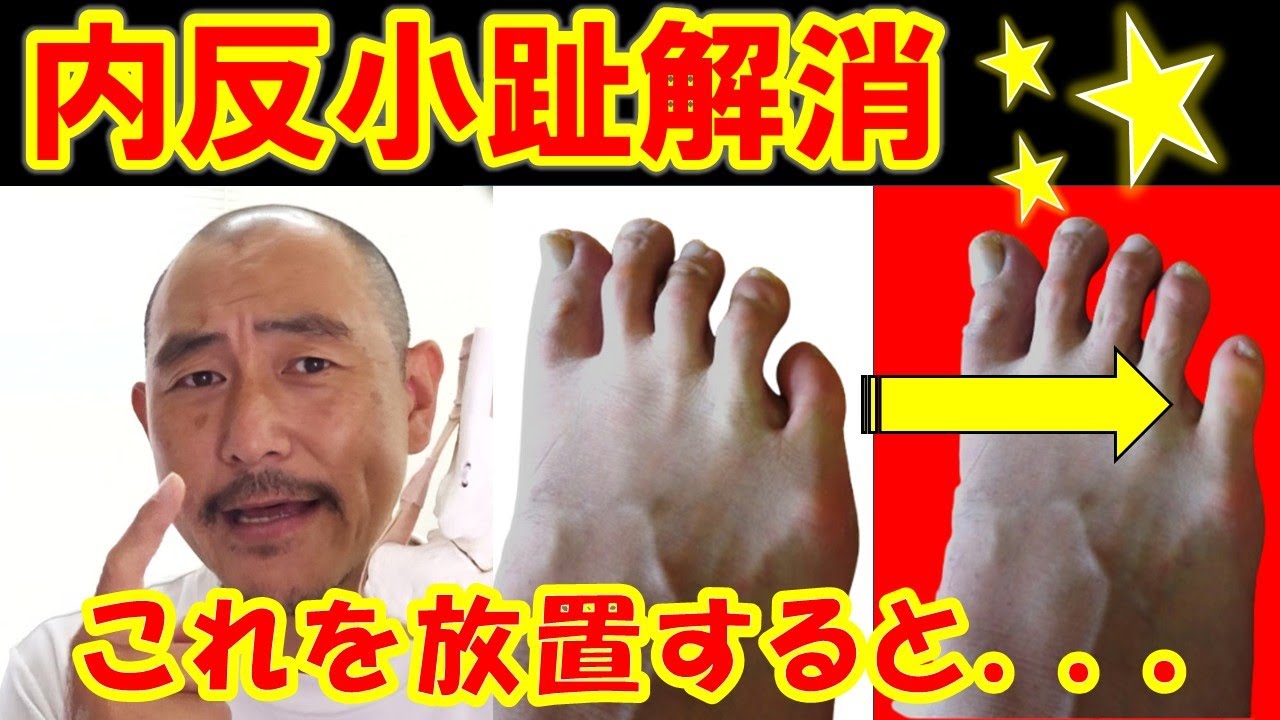 足の専門家が明かす内反小趾はこれで改善