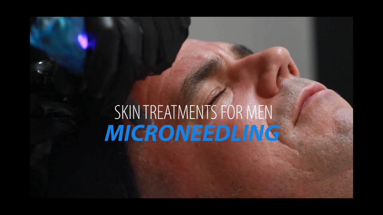 WHAT IS MICRONEEDLING//WHAT ARE THE BENEFITS OF MICRONEEDLING FOR MEN//SKIN TREATMENTS FOR MEN//