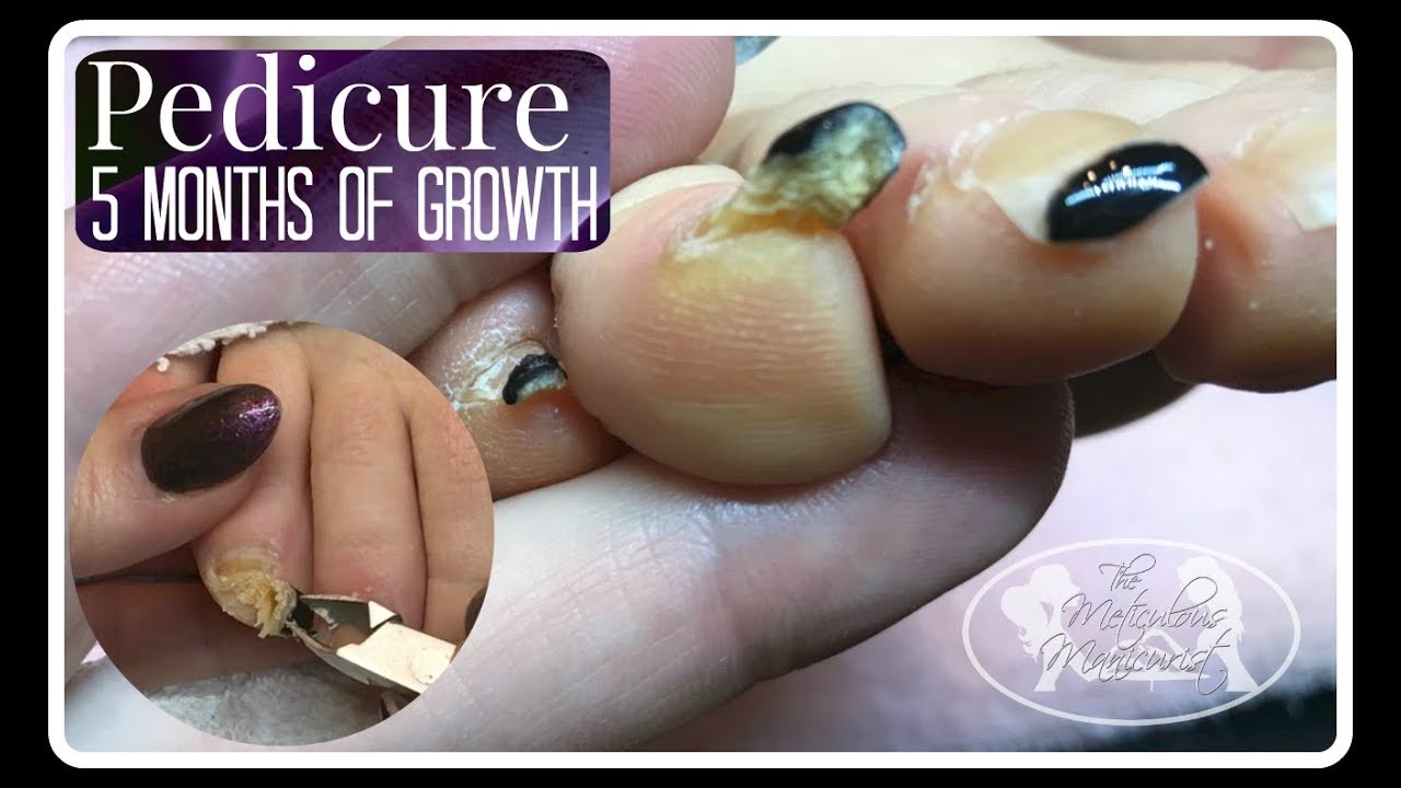 Pedicure Tutorial: How to Cut Long Thick Deformed Toenails and Gel Polish