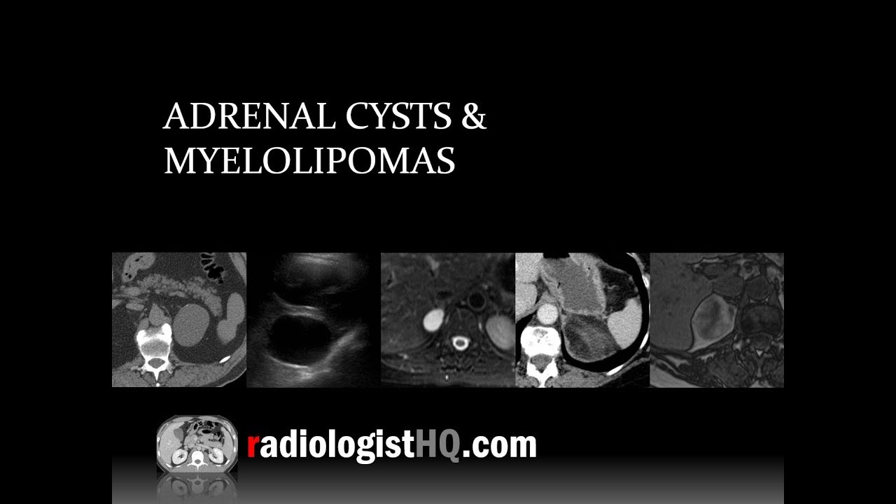 Adrenal Cysts and Myelolipomas