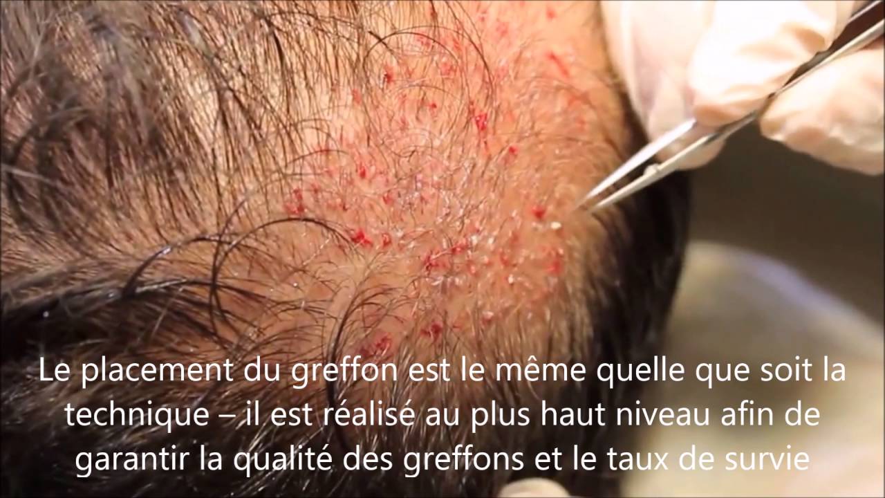 Les Techniques de Greffe Capillaire FUT et FUE Laquelle est la meilleure ? - Vinci Hair Clinic