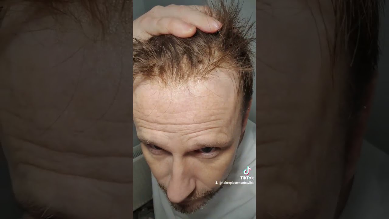 Lace Hair system hairline close up .. Fitted April 2022 ..thinning hairline but still good!!