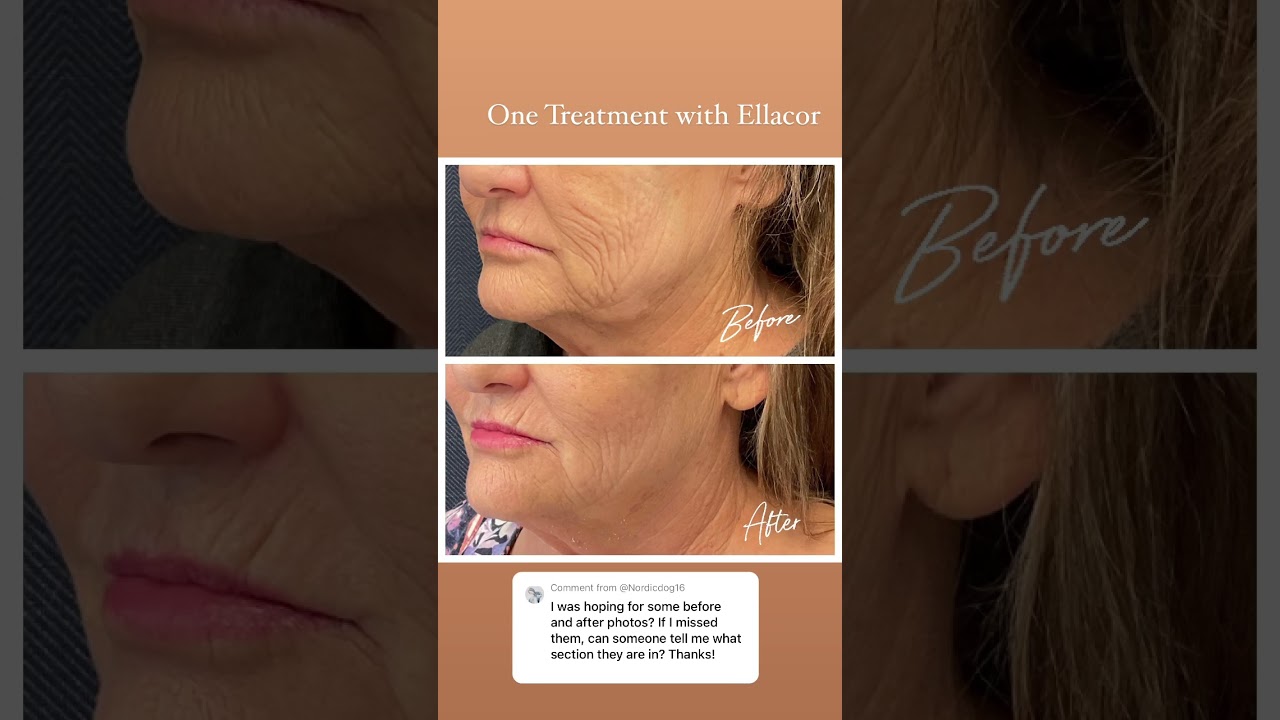 Non-surgical face lift 