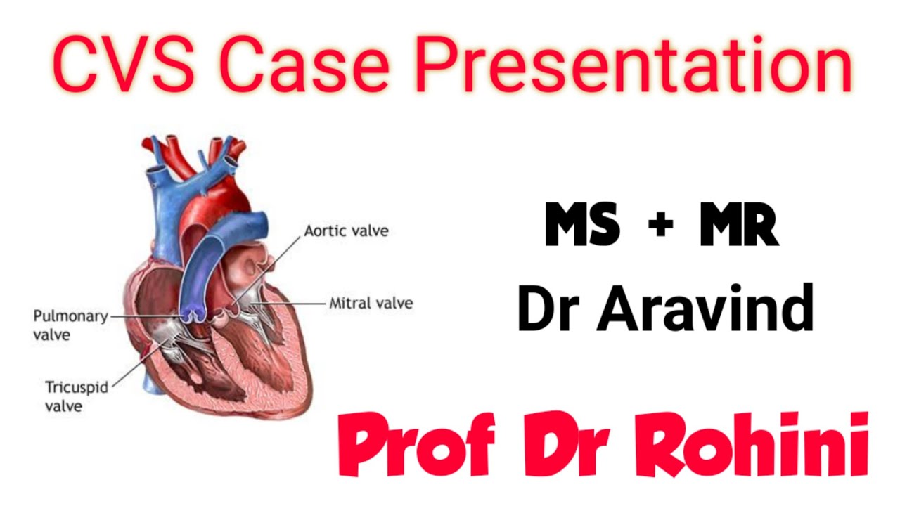 CVS Case Presentation -   Mitral stenosis with Mitral Regurgitation - Dr Aravind & Prof Dr Rohini