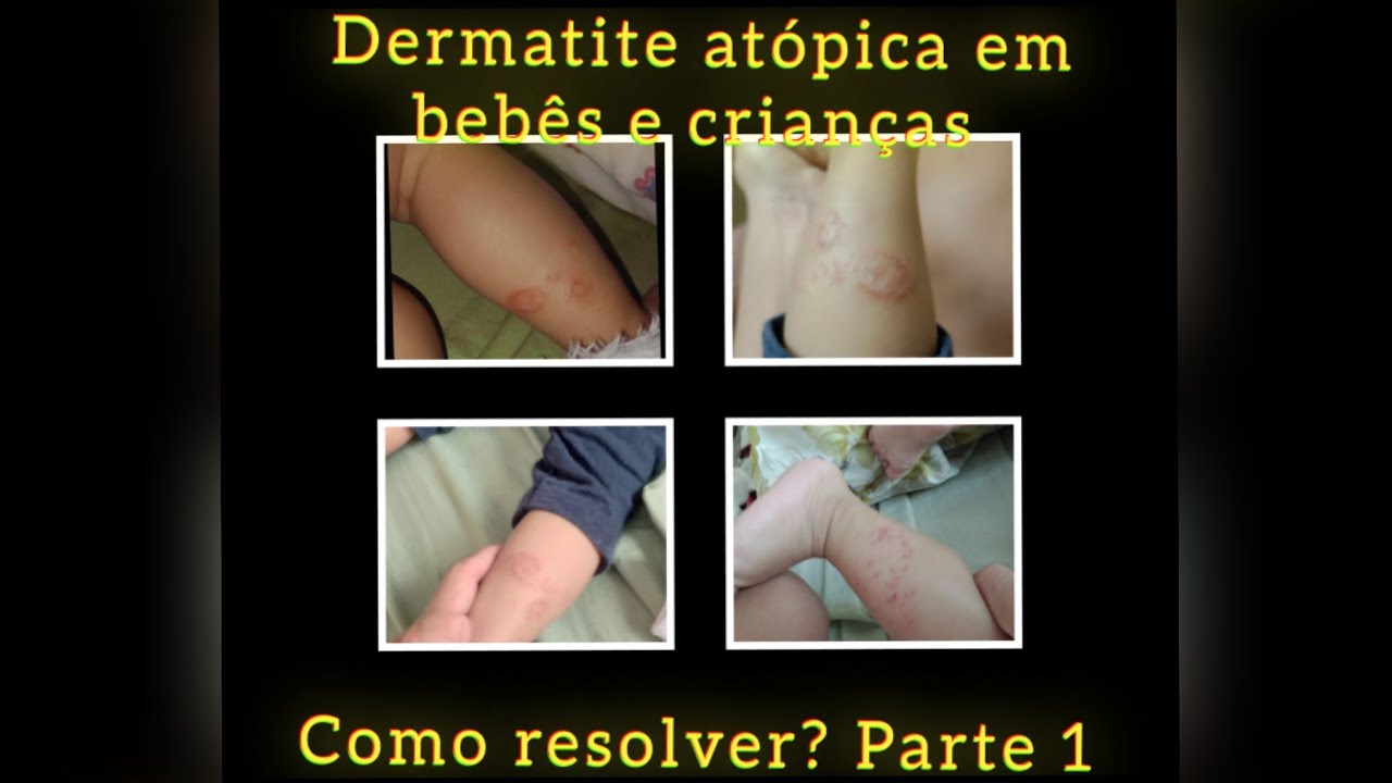 Dermatite atópica em Bebês e crianças minha experiência #aplv #dermatiteatopica