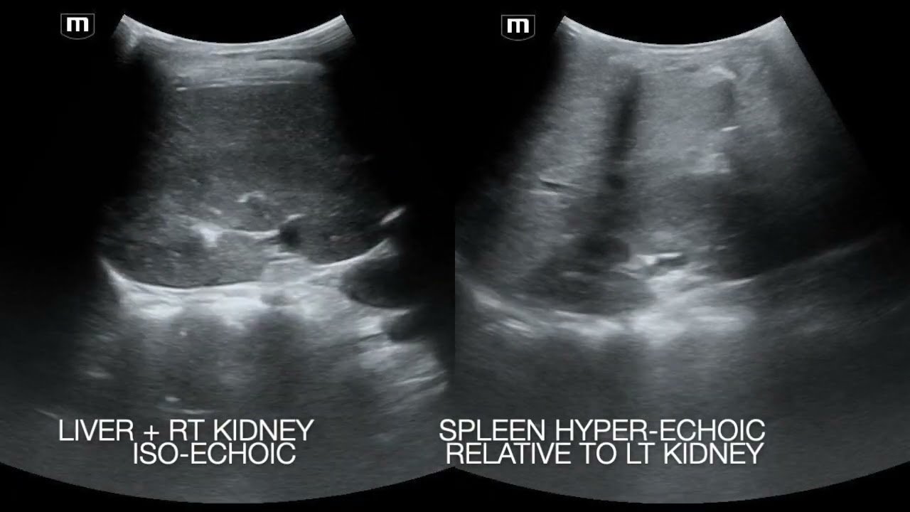 Acute Splenic Sequestration in 6 year old boy with Sickle Cell SS Disease