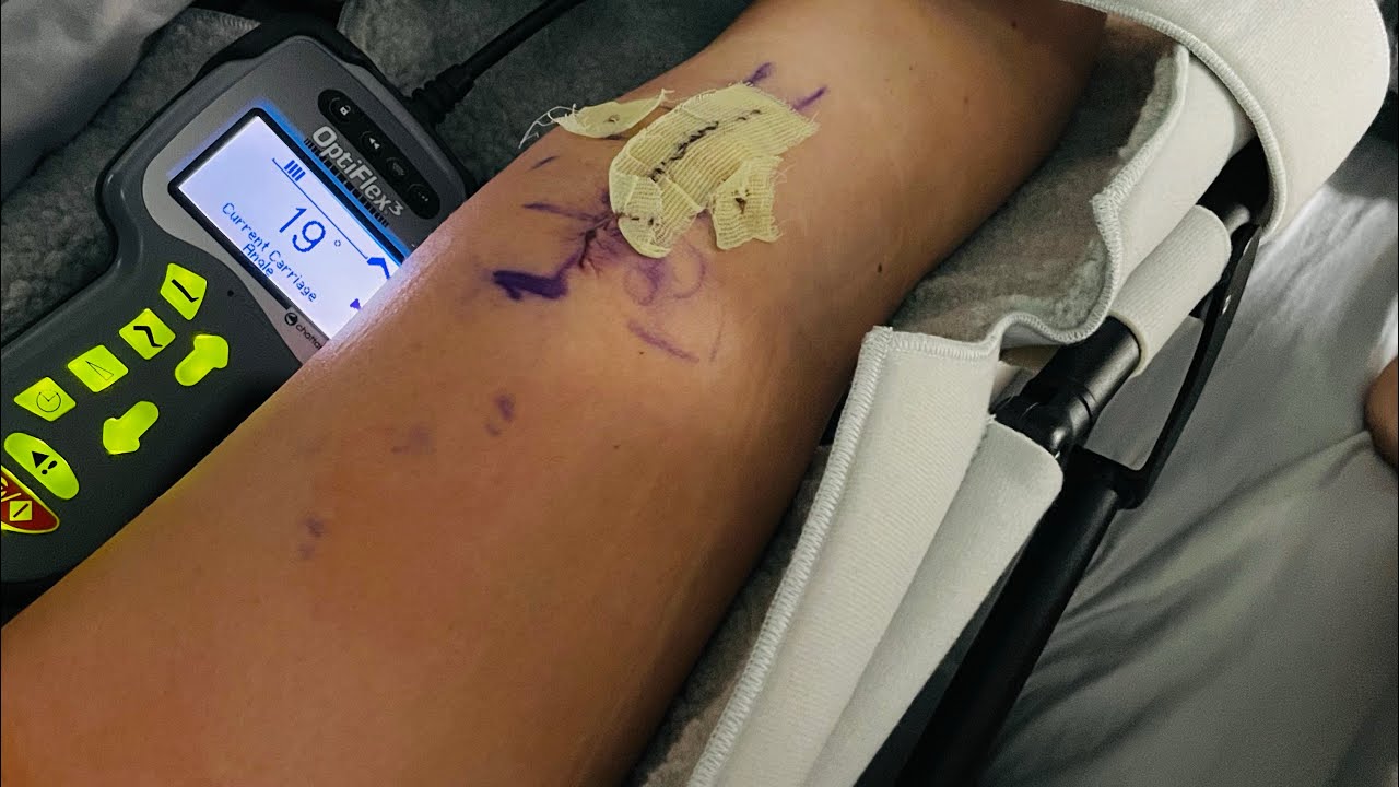 MACI Knee Surgery: One Week Post-Op