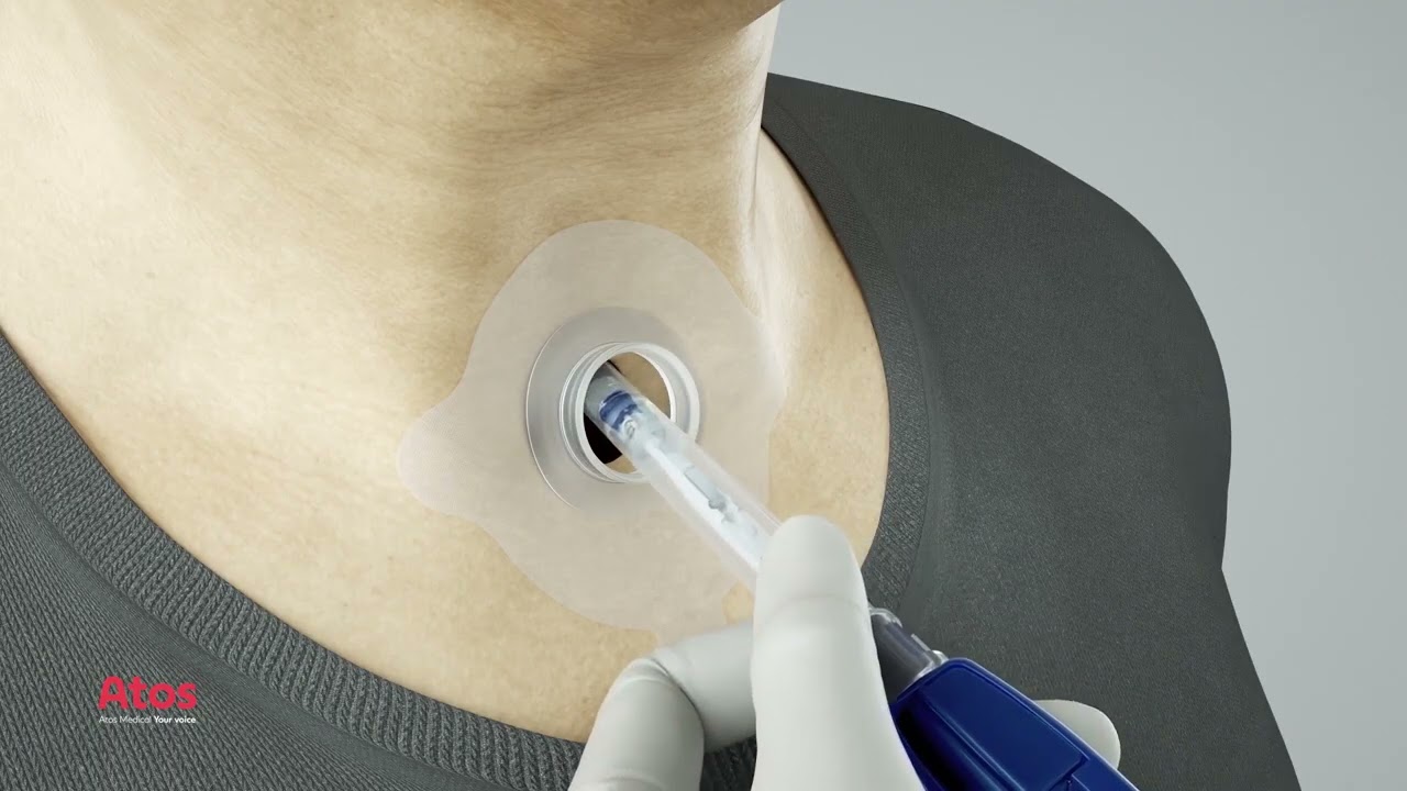 Changing the Provox Vega Voice Prosthesis.