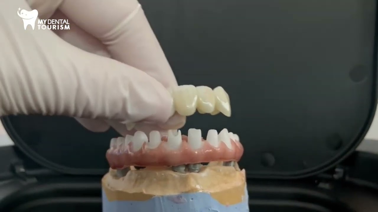 Barra del ponte in zirconio;corone in zirconia su culti in zirconia.