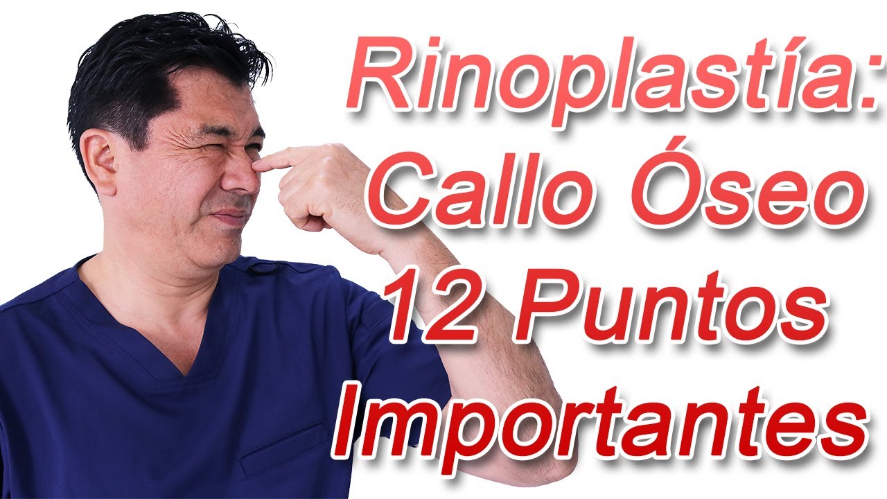 12 Puntos Importantes Sobre El Callo Óseo - Rinoplastía