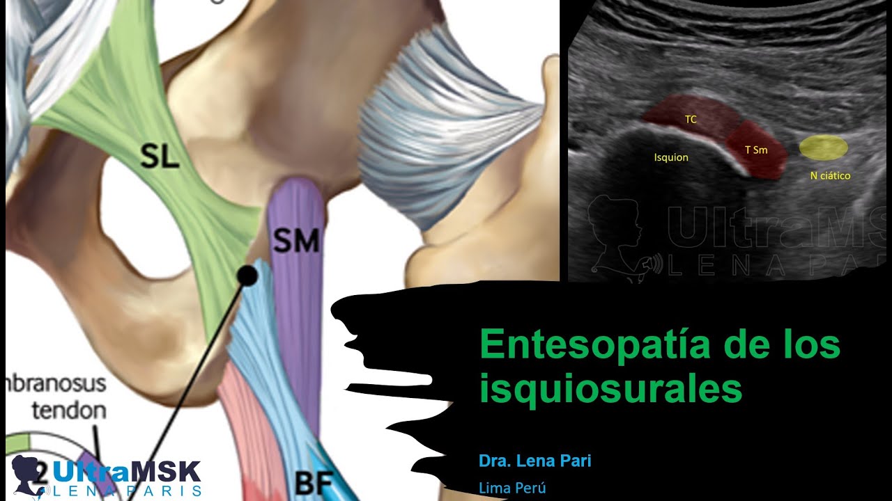 Como evaluar la entesopat&iacute;a de los isquiosurales?/ isquiotibiales / hamstring?  Dra. Lena Pari