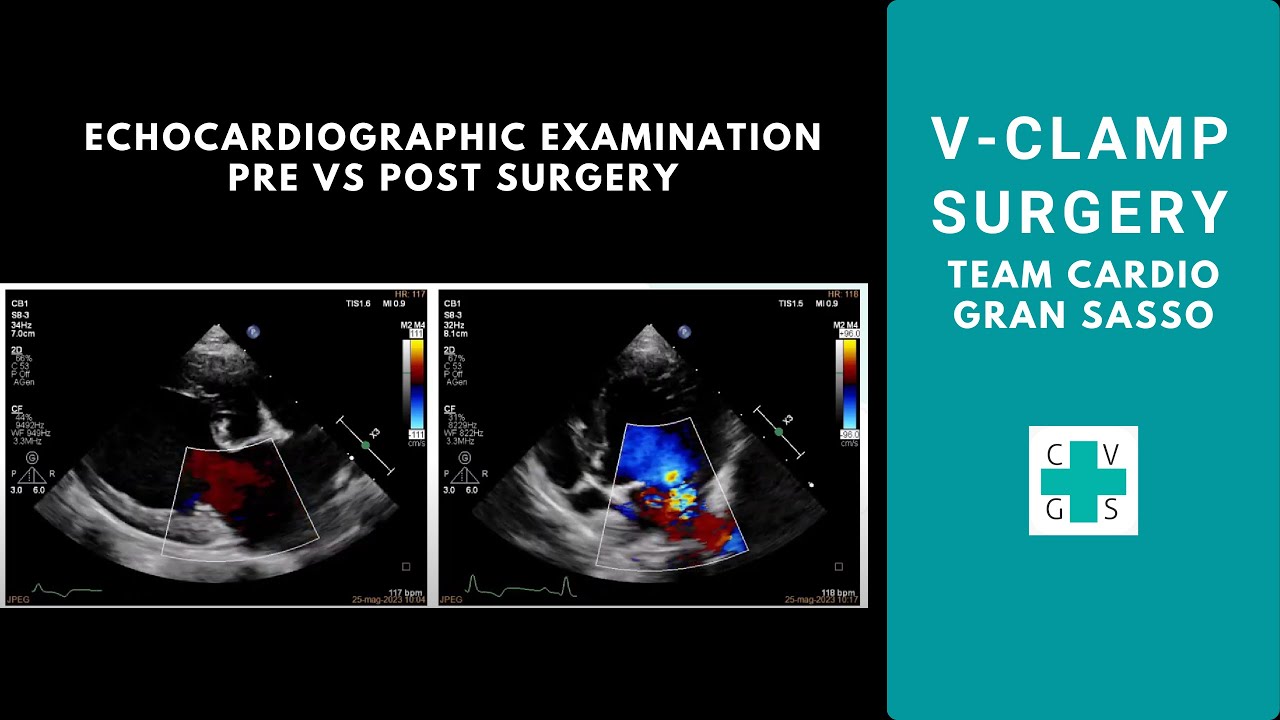 V-Clamp - Confronto tra l’esame ecocardiografico prima e dopo il nostro intervento
