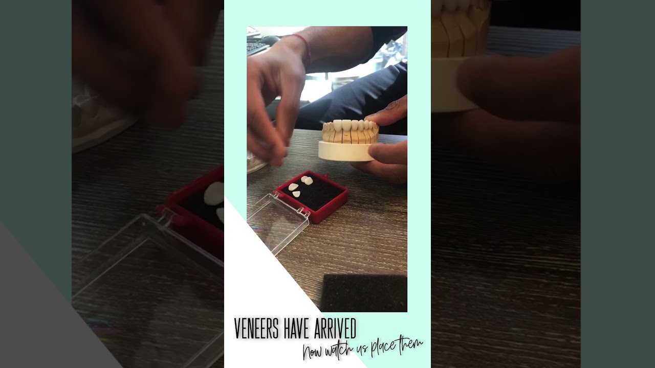 Minimal Prep Porcelain Veneers