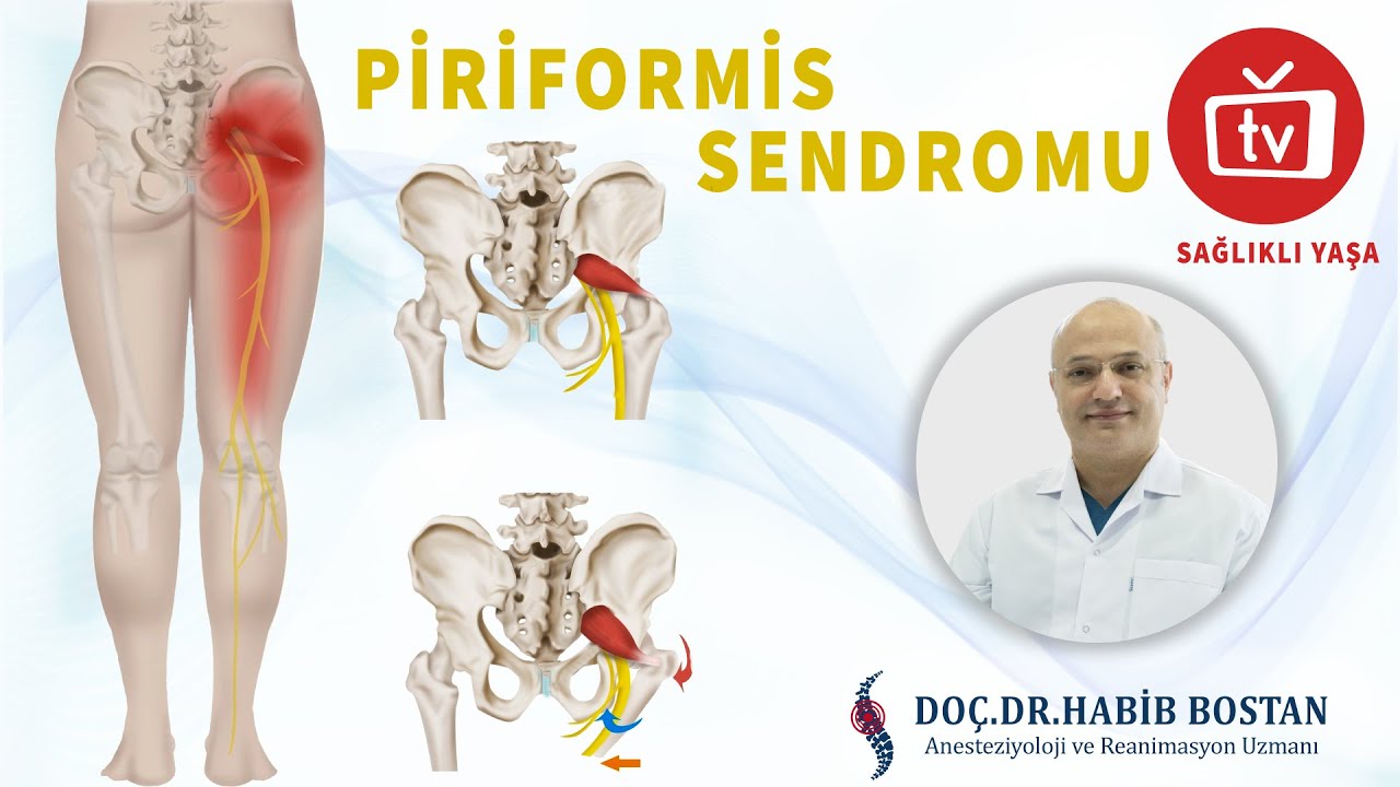 DOÇ. DR. HABİB BOSTAN -  PİRİFORMİS TEDAVİSİ NEDİR ? (SAĞLIKLI YAŞA PROGRAMI )