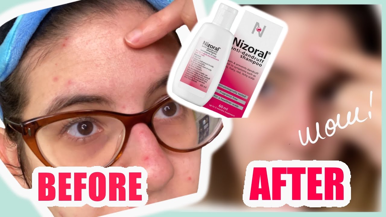 Nizoral Shampoo Against Fungal Acne - Is it Effective?