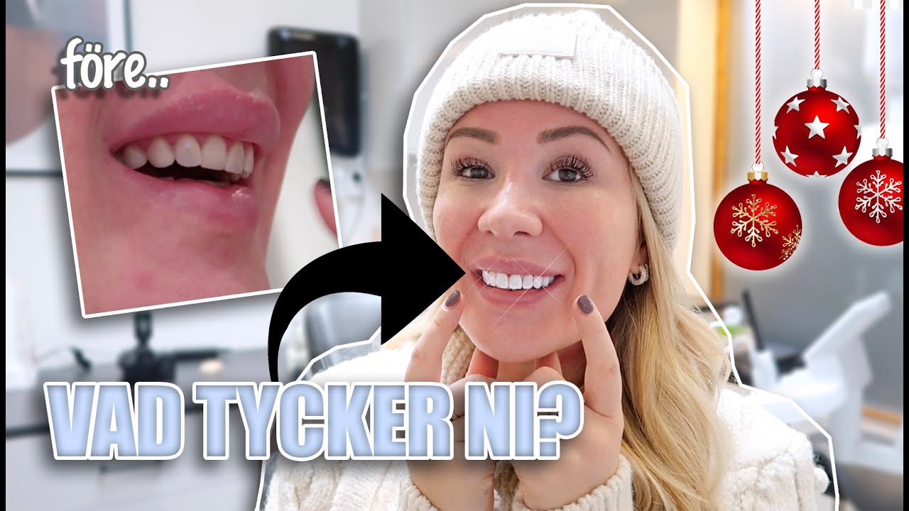 VLOGG - Jag får tandfasader, oj vilken skillnad! Samt lite julpyssel.