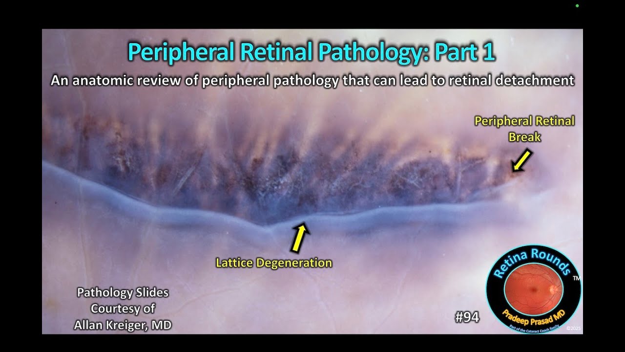 RetinaRounds™ 94: Peripheral Retinal Pathology: Part 1