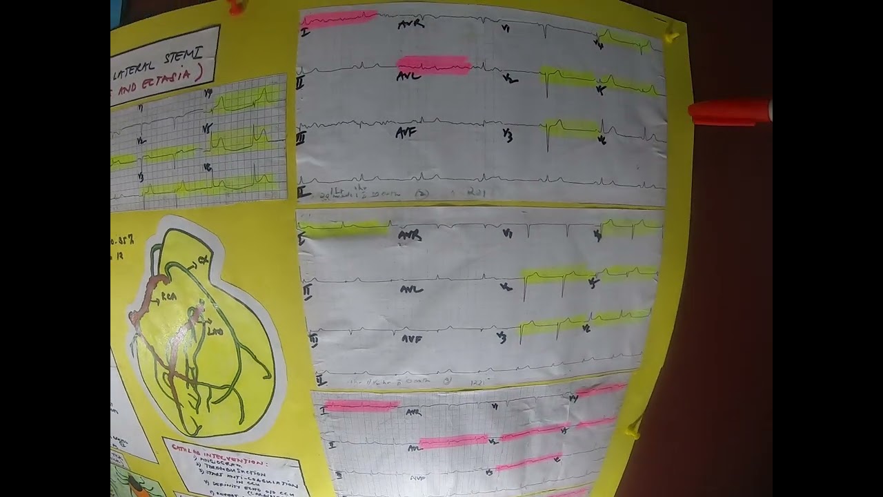 ENG-1A: ANTERO-LATERAL STEMI (D/T ECTASIA W/ CLOTS)