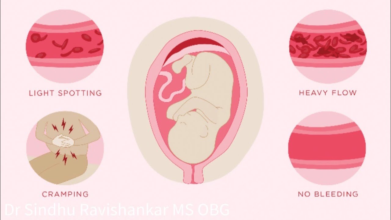 Bleeding in pregnancy | Implantation bleeding | Explained in Kannada | Dr Sindhu Ravishankar