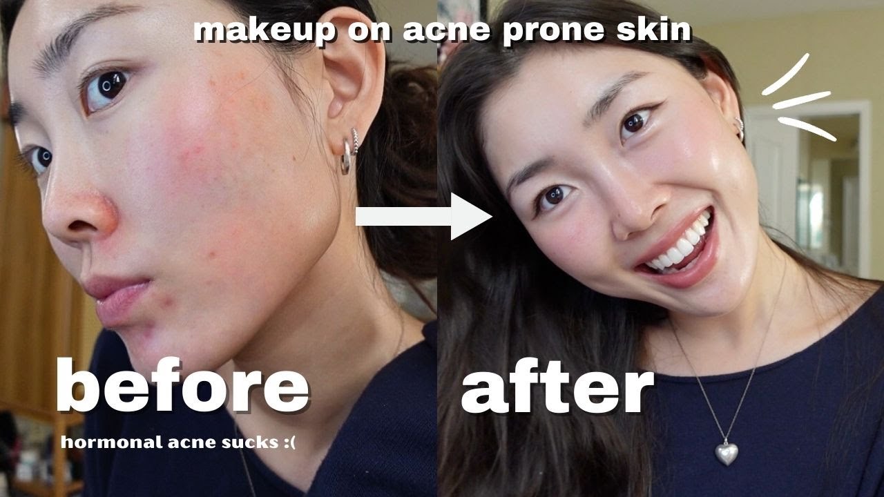 NO FOUNDATION: your skin but BETTER makeup routine for acne prone skin!