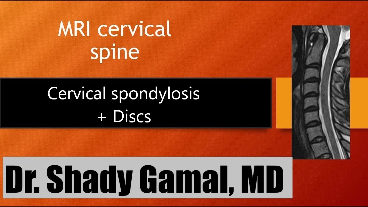 3. MRI Cervical spine spondylosis and discs