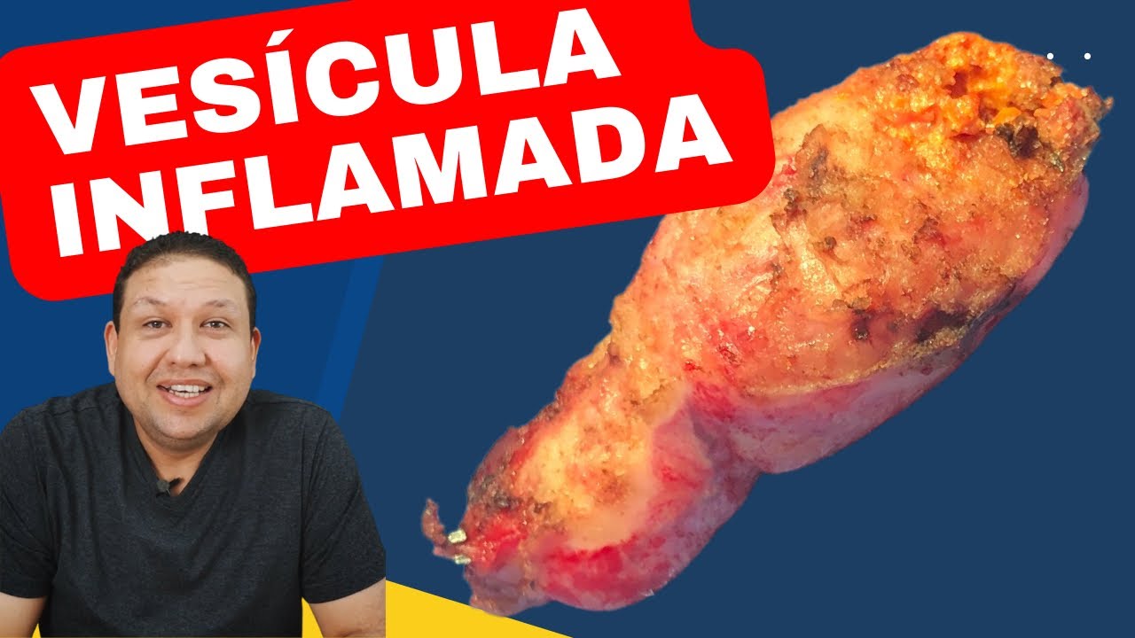 VESÍCULA INFLAMADA ??  Vesícula inflamada, sintomas e tratamento de pedra na vesícula !!!!