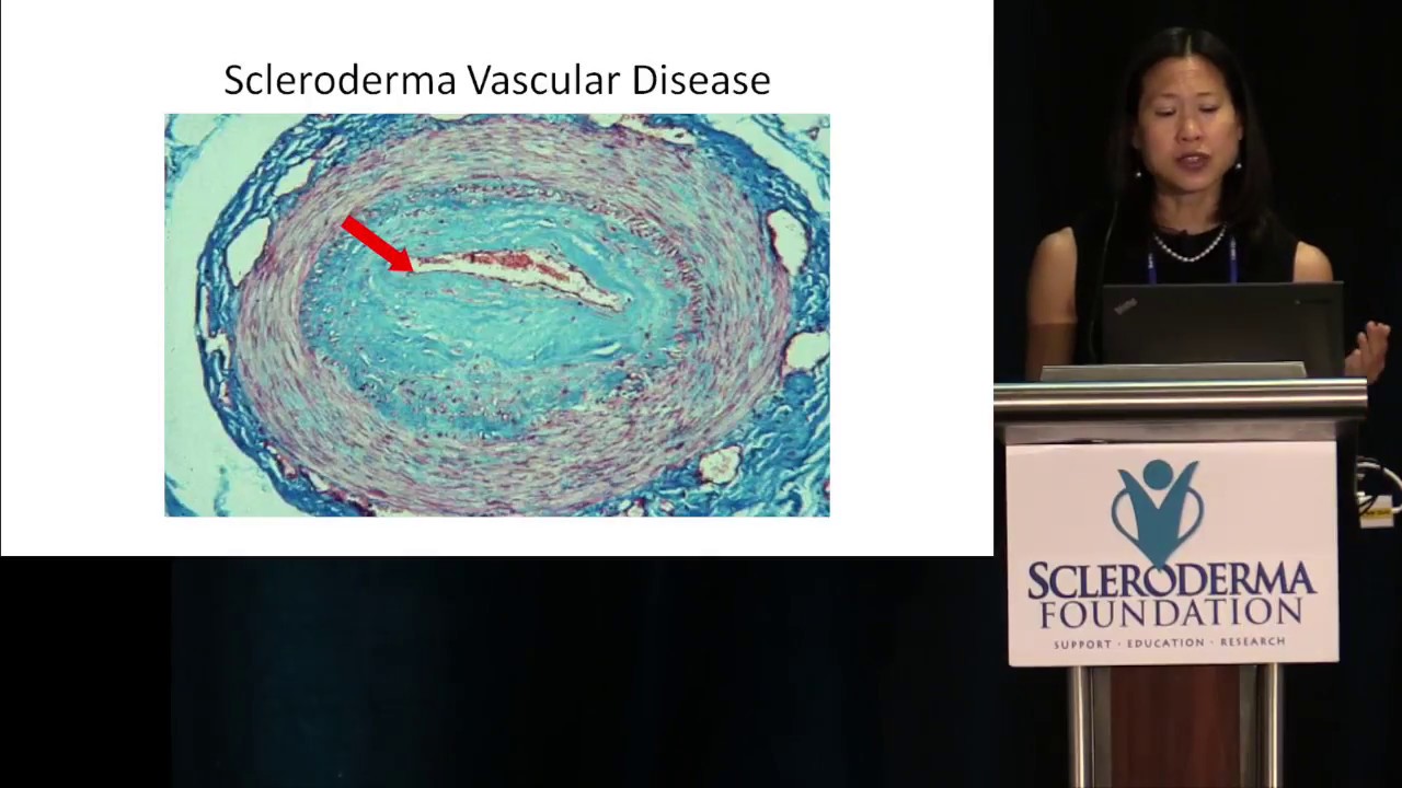 Pulmonary Hypertension in Systemic Sclerosis in the Current Era- Lorinda Chung, M.D., M.S.- 2018